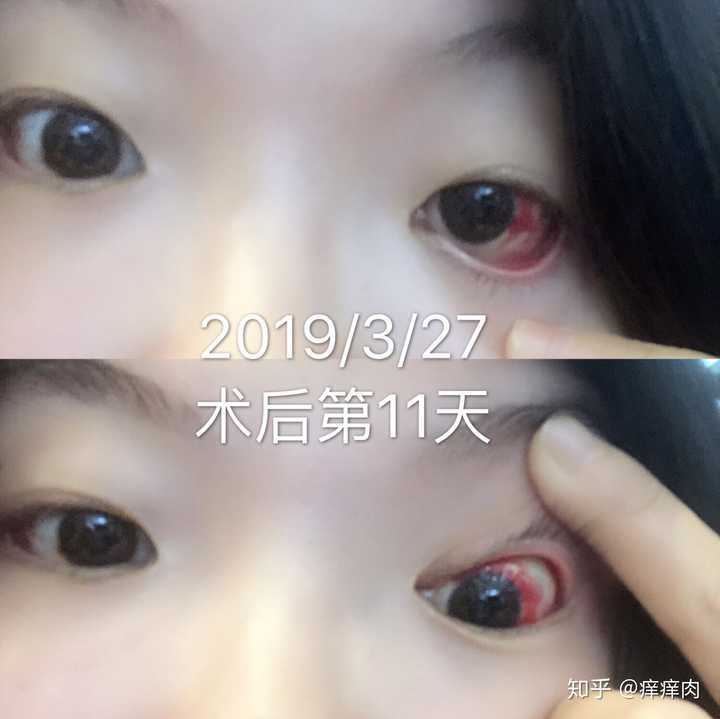 斜视矫正手术 斜视矫正手术
