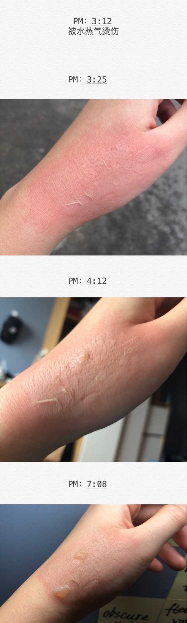 烫伤前后皮肤的具体变化是怎样的 知乎 烫伤前后皮肤的具体变化是怎样的 知乎
