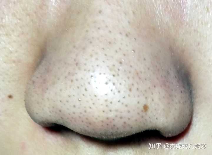 油性皮肤鼻子上有黑头毛孔粗大怎么办用什么产品能有效的去除黑头和