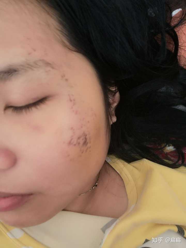 脸部擦伤结痂已经掉了.但是红黑的一片,怎样才能避免留疤?