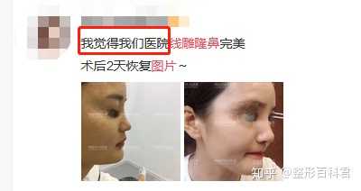 为什么现在建议做线雕隆鼻的人这么少 知乎 为什么现在建议做线雕隆鼻的人这么少 知乎