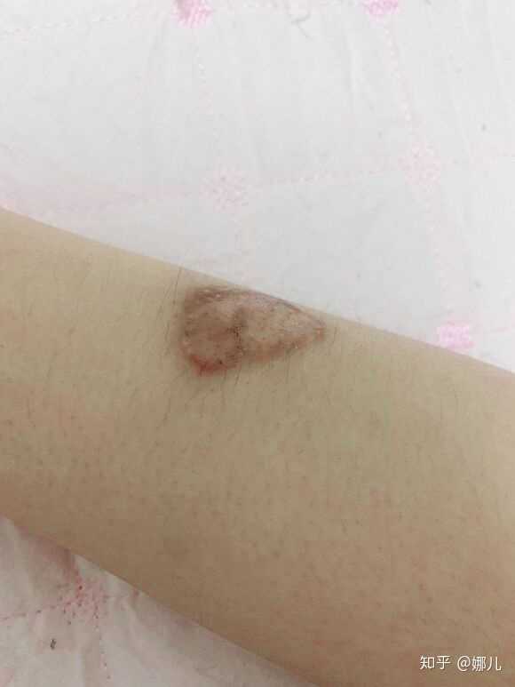 开水烫伤后的黑色素沉淀怎么祛除?