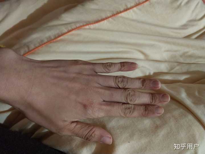 鱼鳞病还有未来吗 知乎