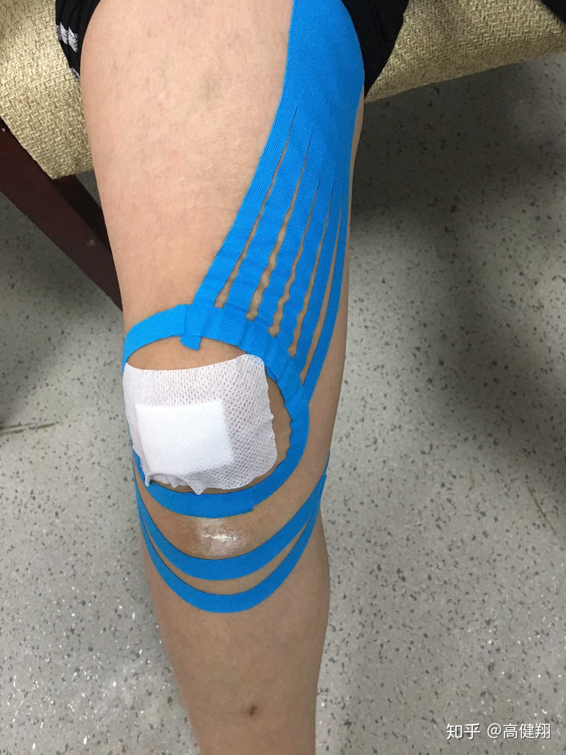 高健翔 的想法: #案例分析# 同事因摔倒,左脚外翻扭伤,… - 知乎
