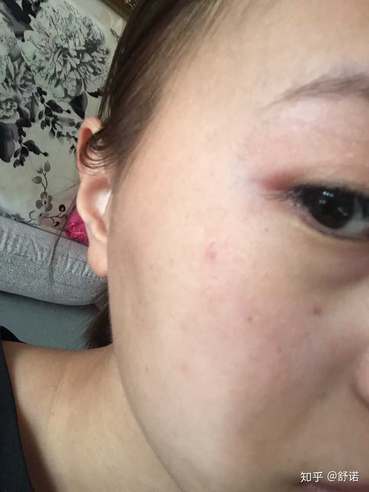 点痣去医院还是去美容院好 知乎 点痣去医院还是去美容院好 知乎