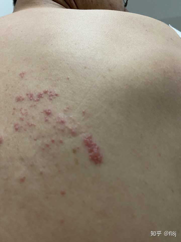 得了带状疱疹的症状及感受是什么 知乎 得了带状疱疹的症状及感受是什么 知乎