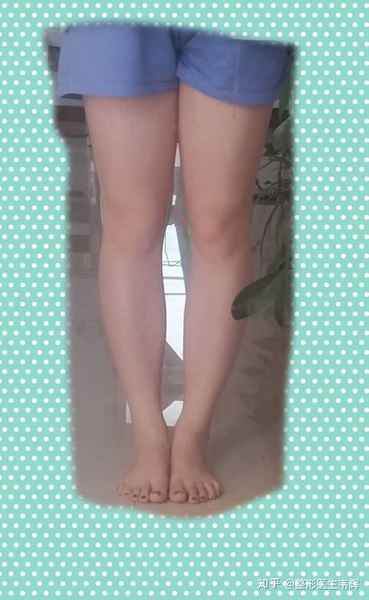 我的腿型是o型腿吗?还是正常的?