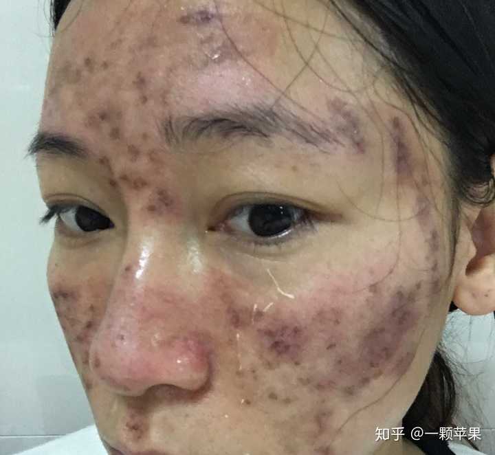 如果你也有一脸痘痘,你会怎么样生活? - 知乎