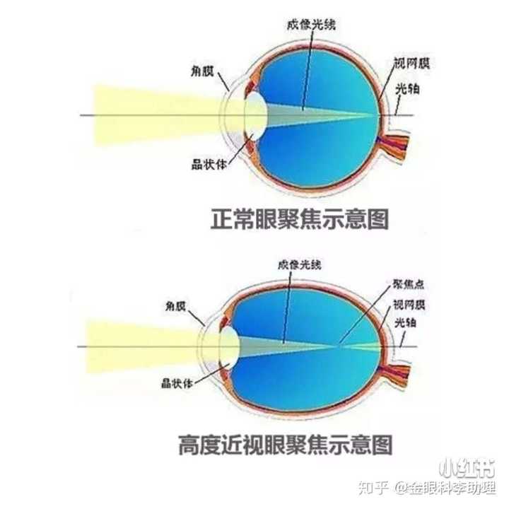 佩戴眼镜不会导致眼睛会突,是因为近视的人,眼轴会变长,过长的眼轴