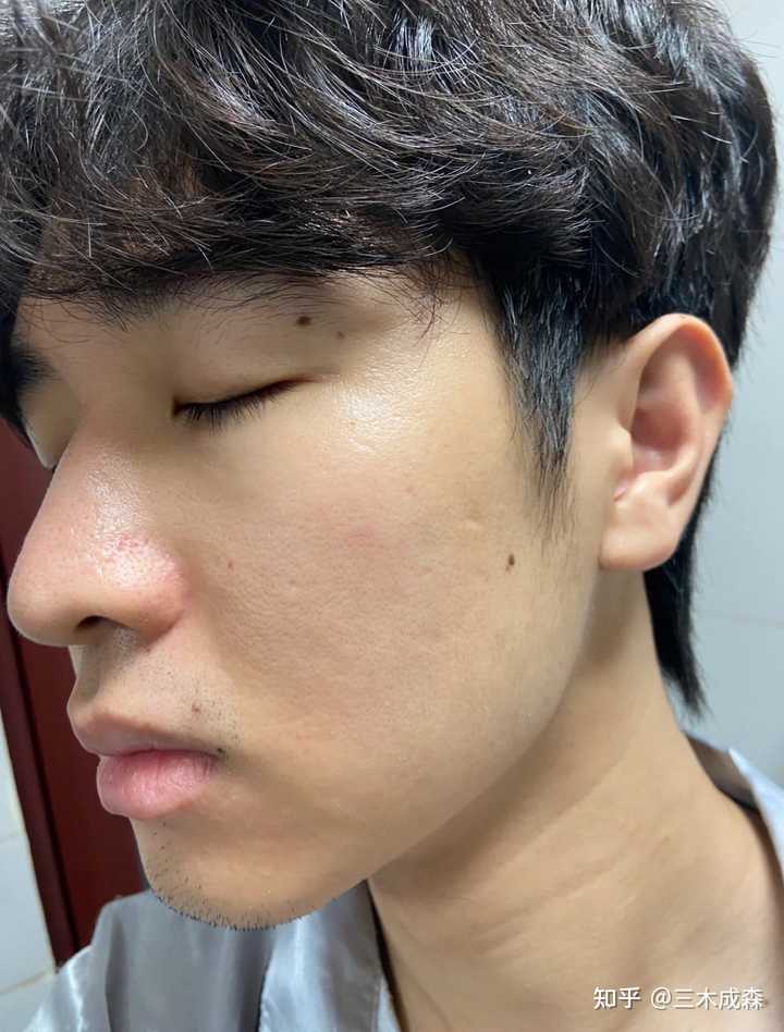 男生皮肤粗糙显老怎么办？