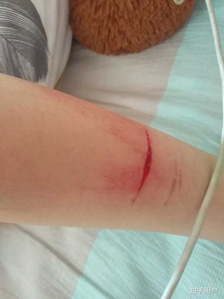 检查抑郁症的所有流程 我想去检查 可我真的很害怕 未成年 伤口都藏