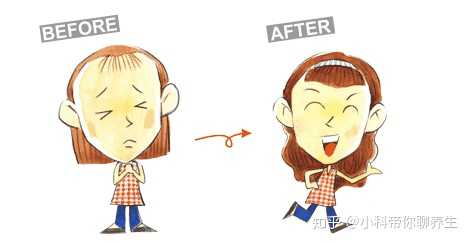 植发脱落期怎么度过?一个月只见掉不见其再长