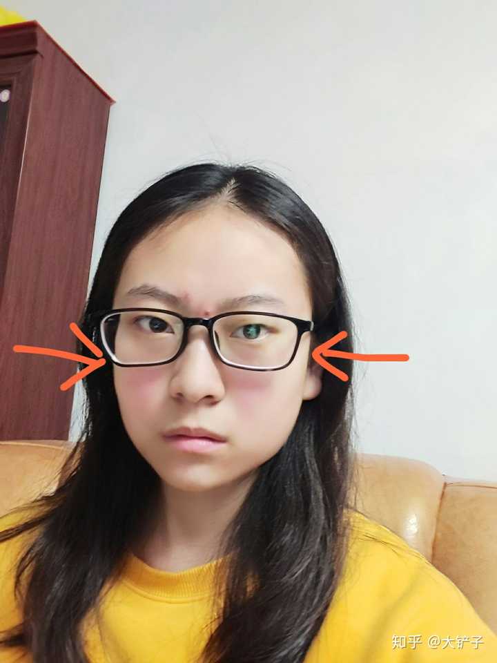 左边脸部凹陷,今年19岁,女生,没有整容史,有知道怎么回事的吗?