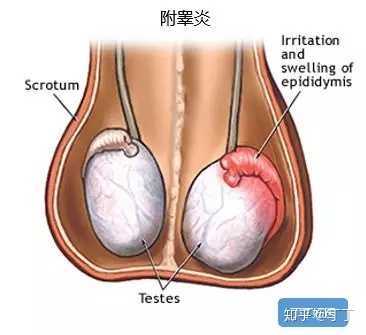 睾丸为什么胀痛 知乎 睾丸为什么胀痛 知乎
