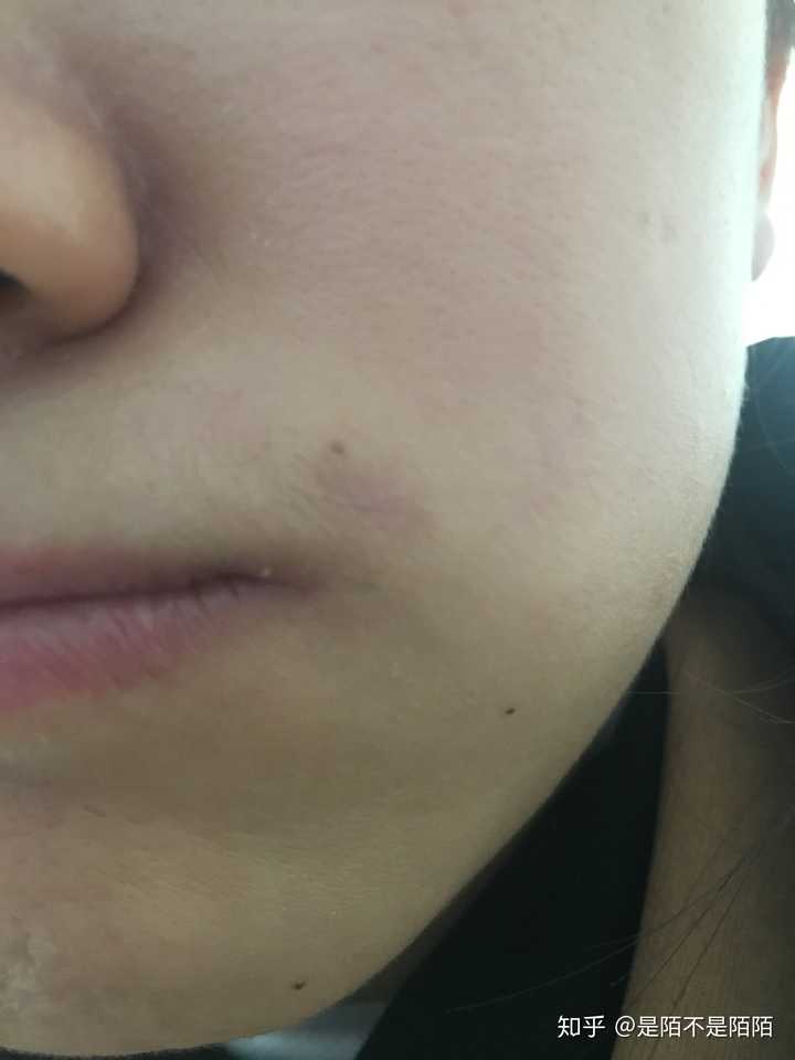 手术祛痣切痣是什么体验?