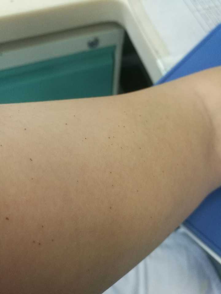 皮肤上面有一些小的血点 像是血不高于皮肤 很小 右胳膊上有很多仔细看 知乎