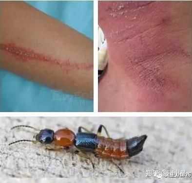被这种虫子爬过皮肤表面,会出现以下症状: 烧灼感---灼痛---皮肤发红