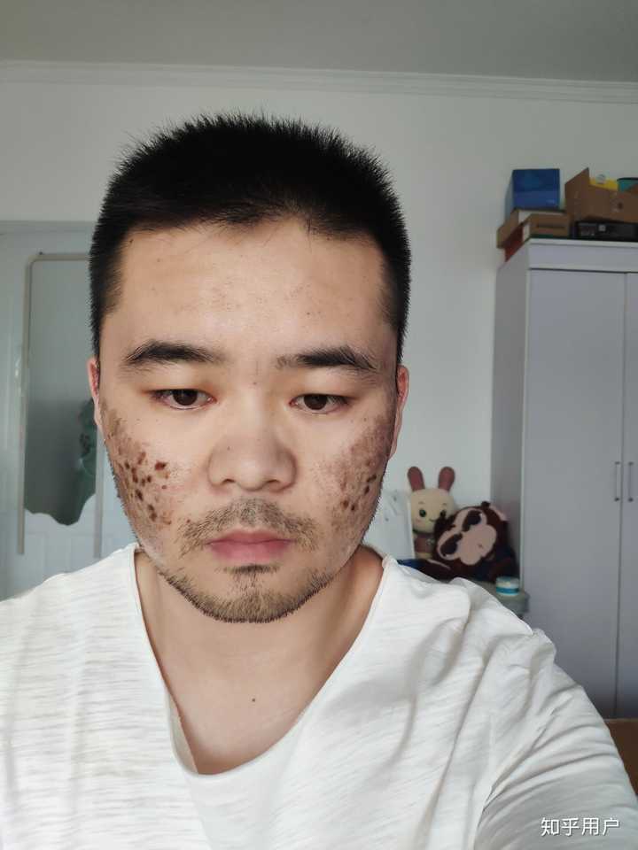 点阵激光去痘坑的效果如何 知乎 点阵激光去痘坑的效果如何 知乎