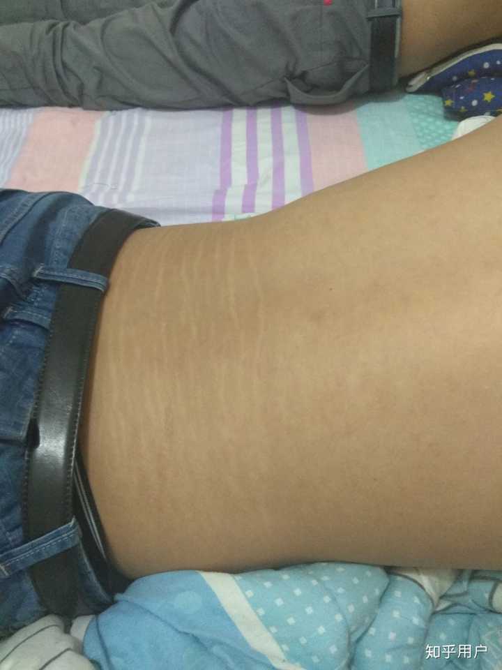 如何避免健身过程中产生的生长纹?