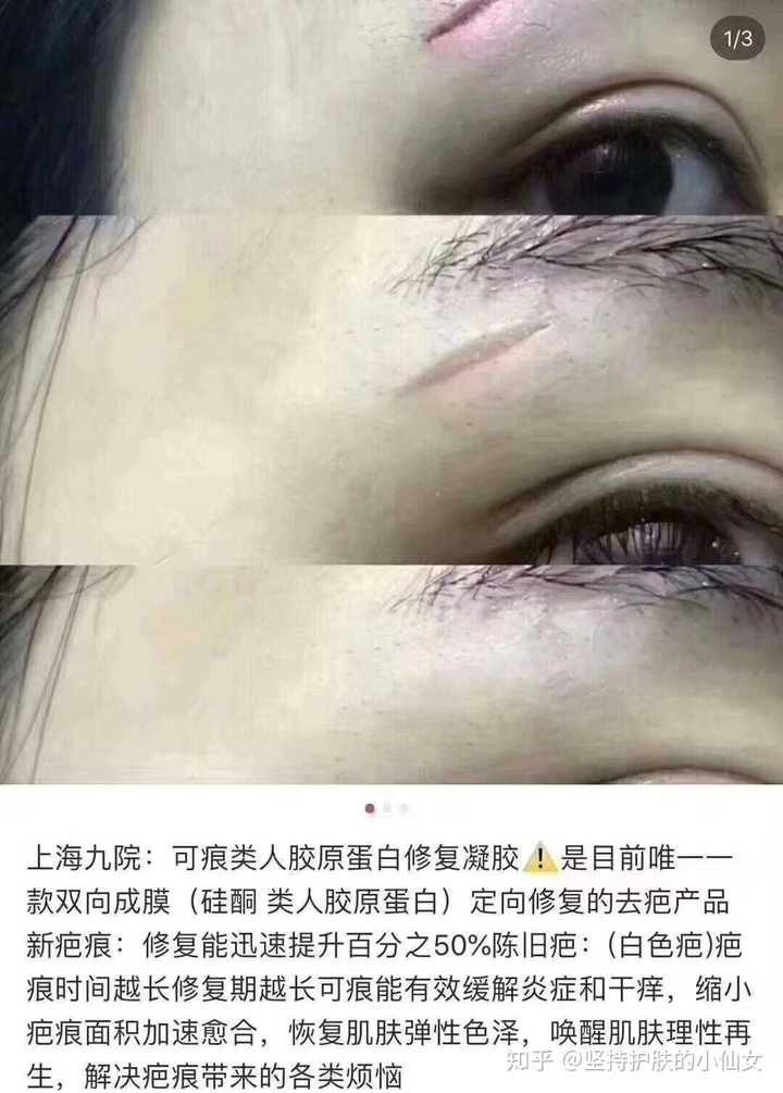 怎麼淡化剖腹產的刀疤?