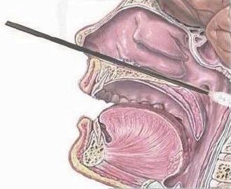 核酸检测插喉示范图图片