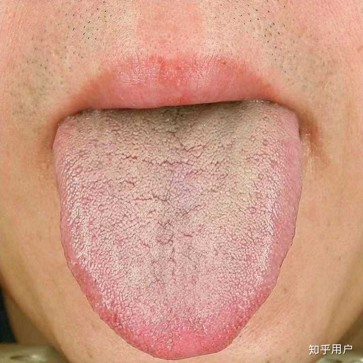 舌苔黄腻,舌头红(图片为湿热体质舌象,非本人,你看有胡子呀)