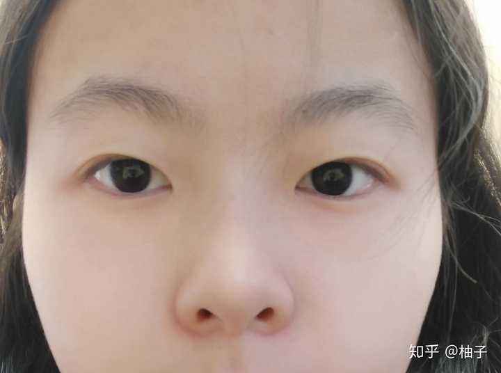 鼻梁根本挂不住眼镜,内眼角下垂,两眼间距过大