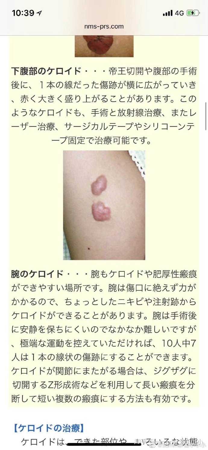 1 年 帝王 切開 傷 1 年 帝王 切開 傷
