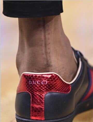 考辛斯跟腱伤口触目惊心