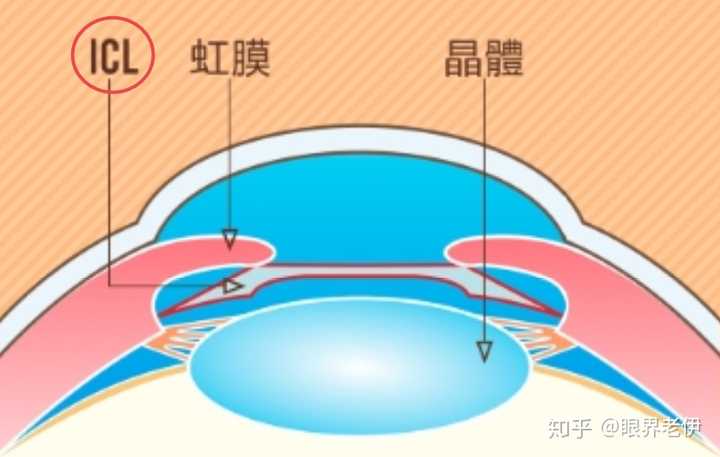 Icl 手术具体有什么风险 术后要注意些什么 知乎 Icl 手术具体有什么风险 术后要注意些什么 知乎