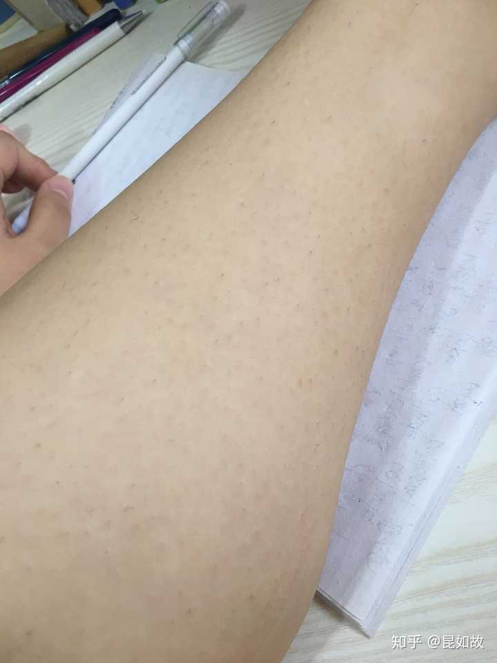 鸡皮肤能脱毛改善吗图片(鸡皮肤能脱毛改善吗图片大全) 鸡皮肤能脱毛改善吗图片(鸡皮肤能脱毛改善吗图片大全)