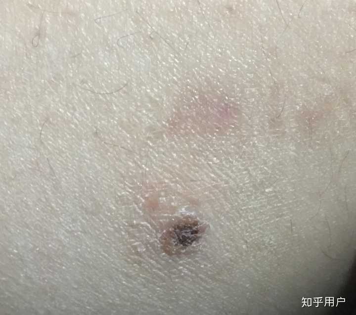 手术切痣是一种怎样的体验?