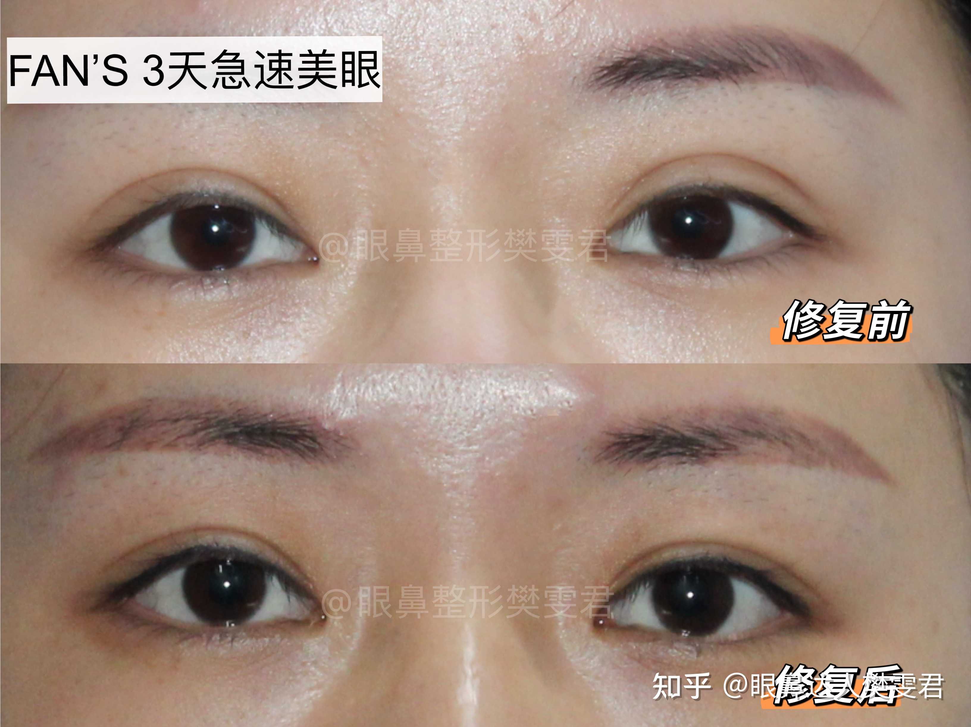 双眼皮修复6个月后对比