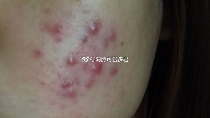 粉刺型?丘疹型还是囊肿型?各种不同的处理方法和注意事项?