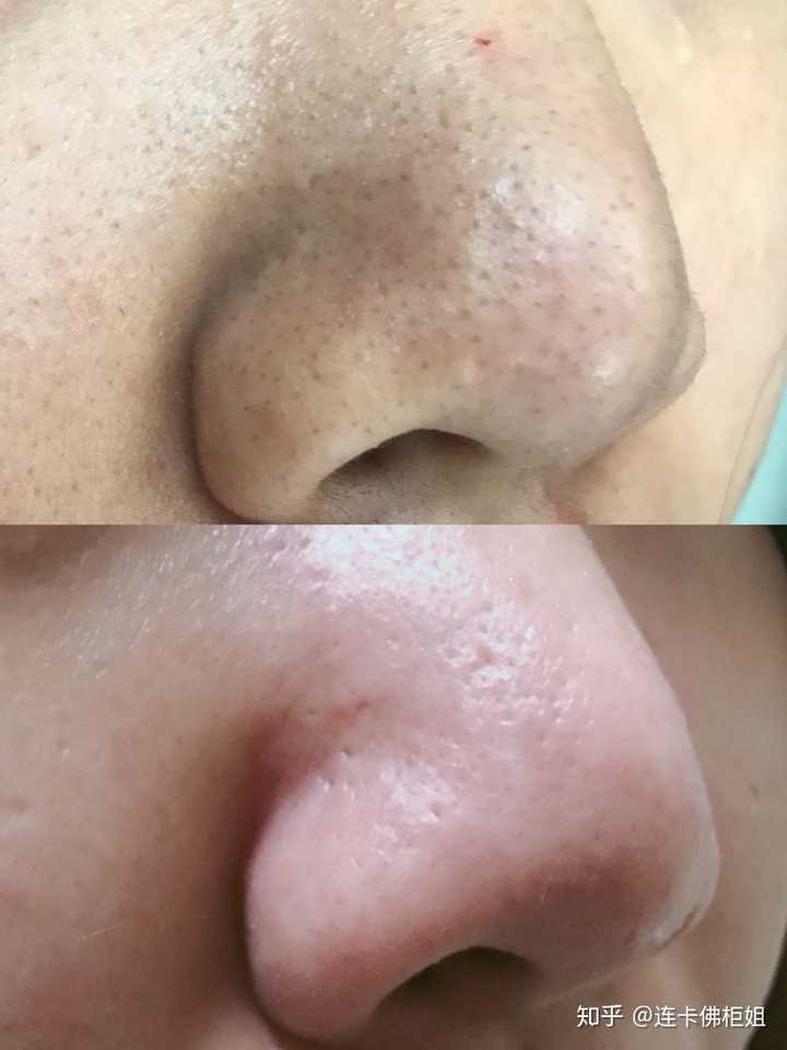 如何去除鼻子上的白色脂肪粒 知乎 如何去除鼻子上的白色脂肪粒 知乎