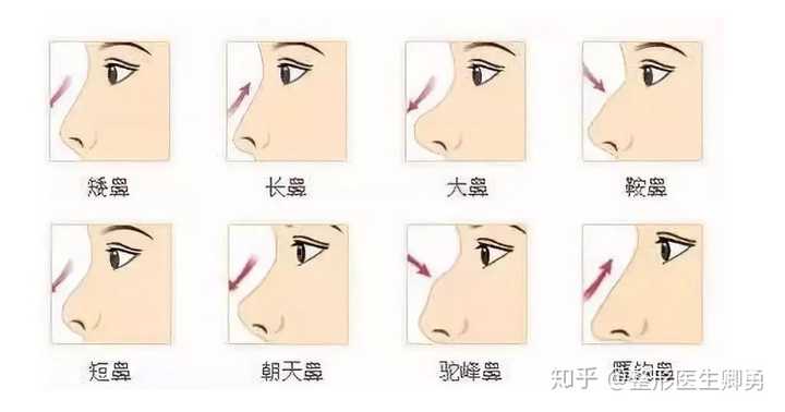 请问这个鼻子是朝天鼻吗?