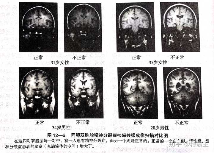 精神分裂症患者的大脑发生了什么 为什么会产生妄想幻觉 言语混乱 知乎