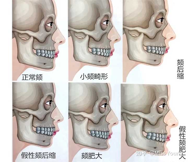 听说下颌骨会长到40岁,是真的吗? - 知乎