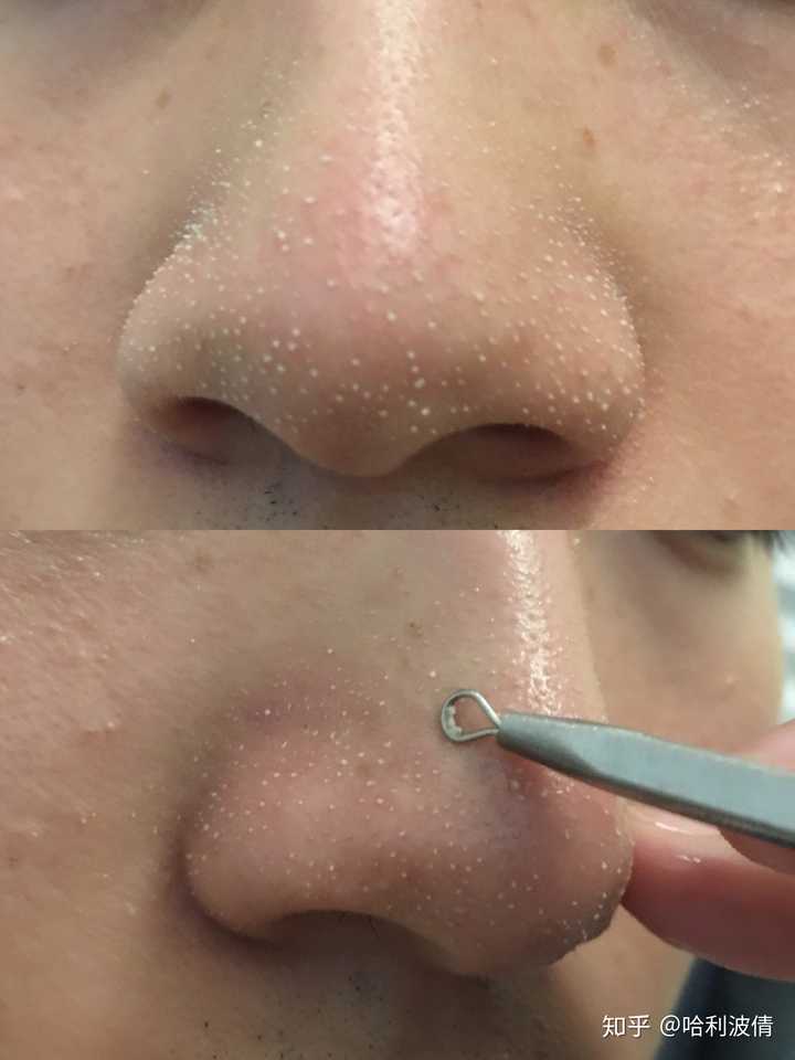 鸡皮疙瘩怎么去除黑头产品的简单介绍