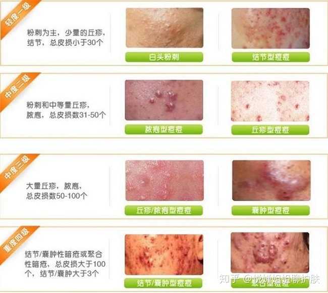 如何治疗白头粉刺? - 知乎