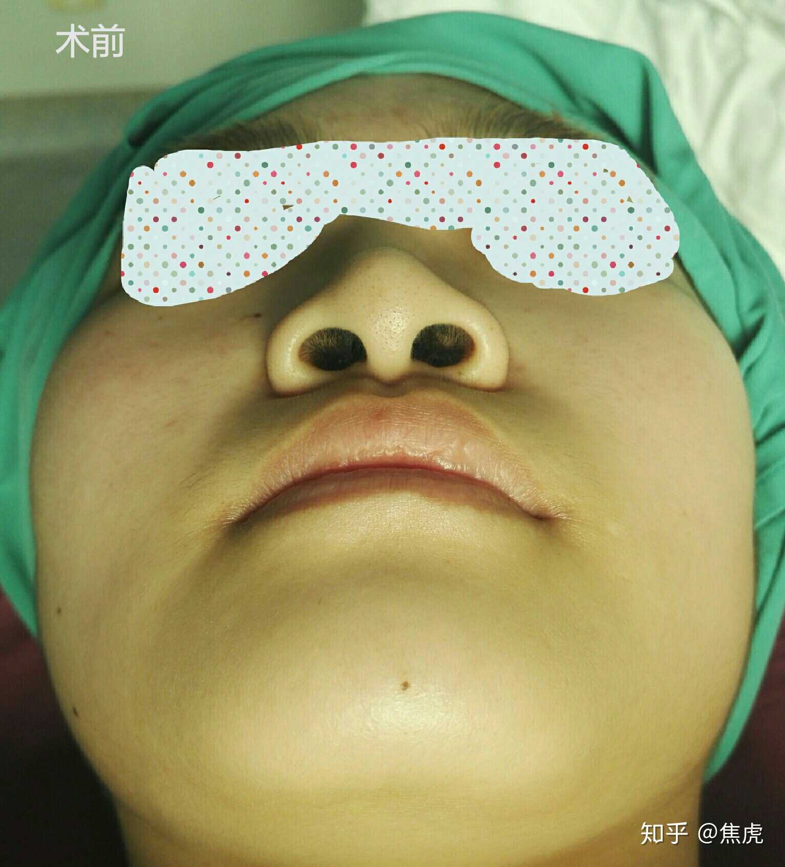 鼻翼缩小手术需要综合考虑鼻翼形态,鼻孔大小以及鼻槛宽度等因素,根据