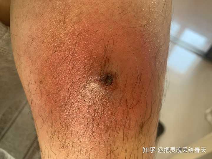 一个火疖子能大到什么地步 知乎