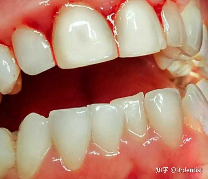 洗牙的过程是怎样的 洗牙后有哪些需要注意的 知乎 洗牙的过程是怎样的 洗牙后有哪些需要注意的 知乎