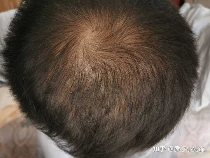 脂溢性脱发,掉发严重洗头掉一大把男性有什么办法吗,男性脱发,24岁