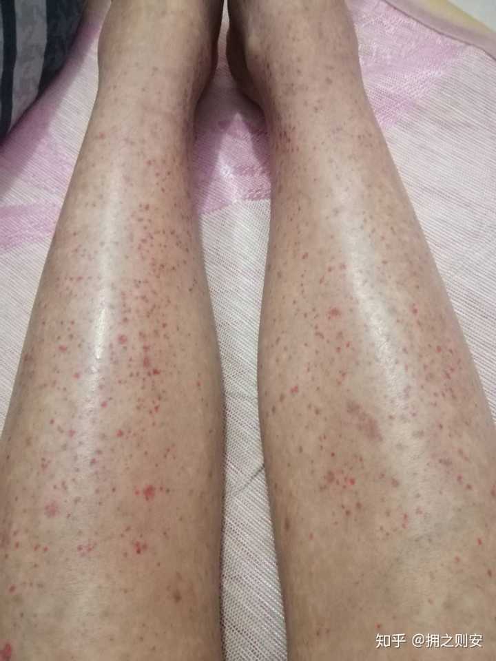成人过敏性紫癜有痊愈的吗？ - 知乎