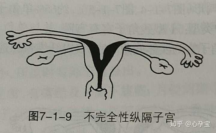 纵隔子宫形状图图片