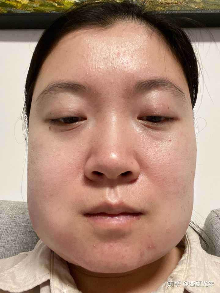 拔智齿脸肿 知乎