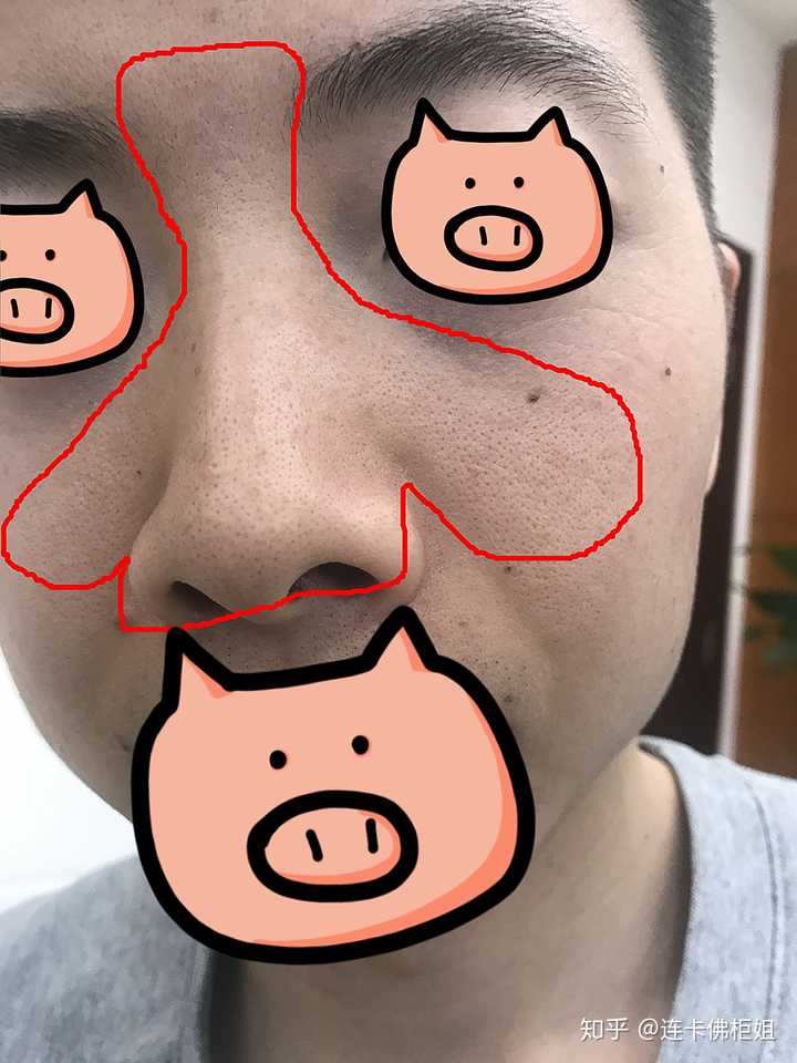 我看到大多数是鼻子上面有黑头,我的是脸颊两边有黑头,怎么去掉?