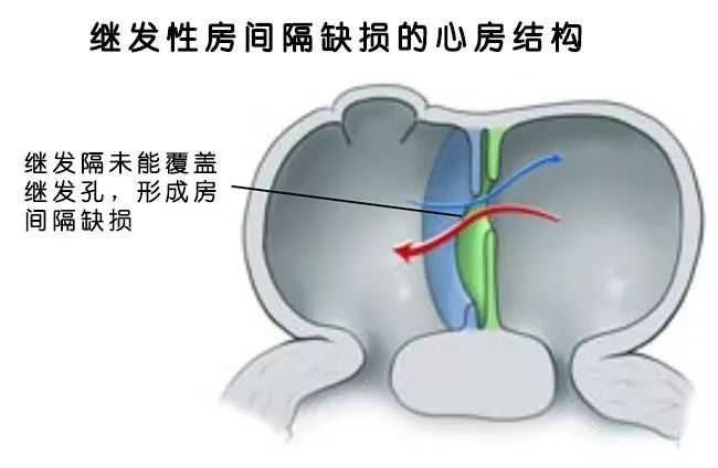 先心病房间隔缺损多大必须手术?