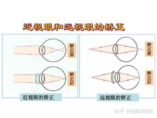 做近视眼手术到底好不好 知乎